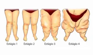 Imagem ilustrativa da imagem Lipedema, a doença que sabota autoestima
