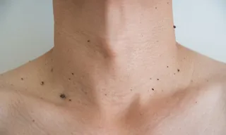 Imagem ilustrativa da imagem Médico diz quando pintas no corpo devem preocupar