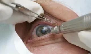 Imagem ilustrativa da imagem Médicos alertam para riscos de cirurgia de mudança da cor dos olhos