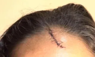 Imagem ilustrativa da imagem Mulher é agredida pelo ex-marido com garrafada na cabeça durante briga em Cariacica