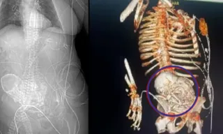 Imagem ilustrativa da imagem Idosa morre após passar décadas com feto calcificado dentro do corpo