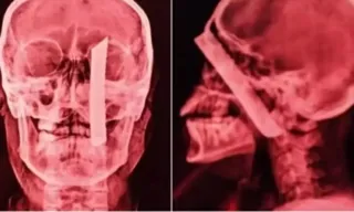Imagem ilustrativa da imagem Mulher sobrevive após cirurgia para retirar lâmina de faca presa no crânio