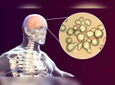 Imagem ilustrativa da imagem Meningite: conheça as causas, os sintomas e as formas de evitar a doença