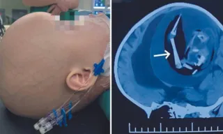 Imagem ilustrativa da imagem “Feto parasita”  de 18 cm é retirado de crânio de bebê