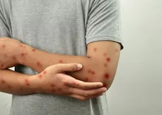 Homem contaminado com a mpox, doença causada 
pelo vírus monkeypox, que causa lesões na pele e febre