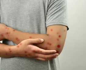 Imagem ilustrativa da imagem Linhares confirma primeiro caso de Mpox