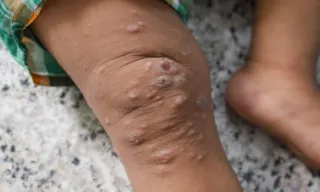 Imagem ilustrativa da imagem Surto de mpox na África preocupa OMS
