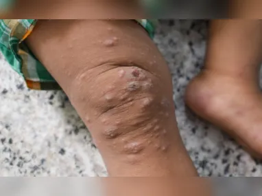 Vacina | Imagem ilustrativa: Ministério da Saúde negocia aquisição de 25 mil doses de vacina contra Mpox