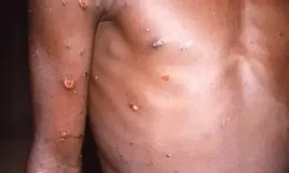 Imagem ilustrativa da imagem Reino Unido registra primeiras transmissões locais de Mpox, diz OMS