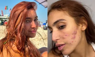 Imagem ilustrativa da imagem Vanessa Lopes fala sobre crise de acne: 'Não aguento mais'