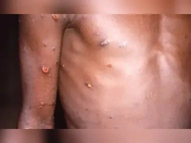 A doença é causada pelo vírus monkeypox, que causa lesões na pele e febre