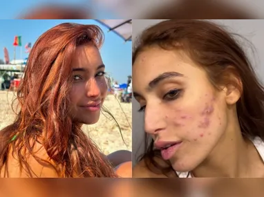 Imagem ilustrativa da imagem Vanessa Lopes fala sobre crise de acne: 'Não aguento mais'