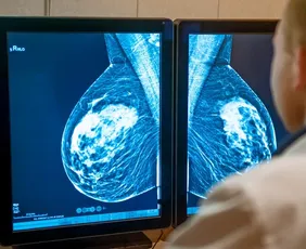 Imagem ilustrativa da imagem Senado aprova projetos que antecipam idade mínima para mamografia no SUS