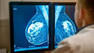 Imagem ilustrativa da imagem Senado aprova projetos que antecipam idade mínima para mamografia no SUS