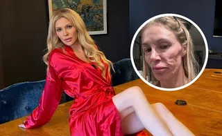 Imagem ilustrativa da imagem Com 'rosto derretido', Brandi Glanville passará por cirurgia; entenda