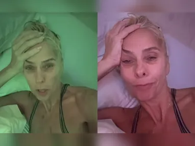 Simone Mendes falou sobre o processo de recuperação das cirurgias