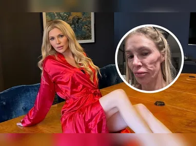 Imagem ilustrativa da imagem Com 'rosto derretido', Brandi Glanville passará por cirurgia; entenda