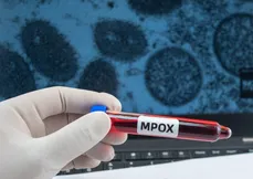 Imagem ilustrativa da imagem Região Norte do Brasil registra casos de mpox