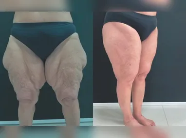 Imagem ilustrativa da imagem Lipedema: entenda doença que afeta 211 mil mulheres no ES