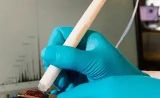 Imagem ilustrativa da imagem Caneta que detecta câncer durante cirurgia chega ao País