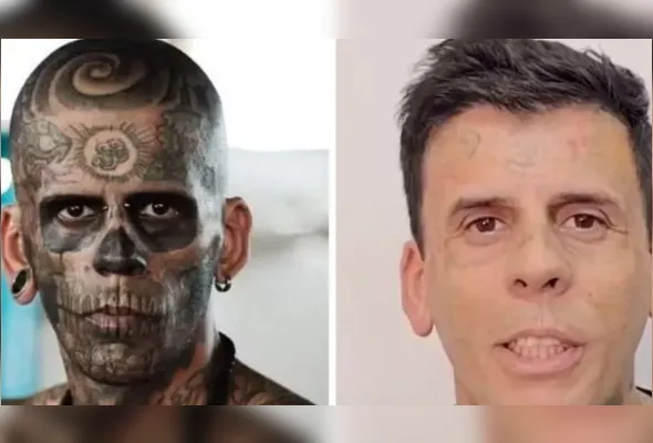 Imagem ilustrativa da imagem Homem mais tatuado do Brasil está irreconhecível após remoção de tatuagens