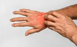 Imagem ilustrativa da imagem Governo de Minas Gerais orienta medidas de controle após surto de sarna humana