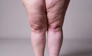 Imagem ilustrativa da imagem Lipedema e o impacto silencioso na saúde mental das mulheres