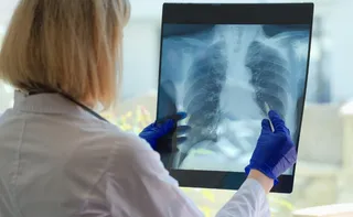 Imagem ilustrativa da imagem Tuberculose mata mais de 1,2 milhão de pessoas por ano, aponta OMS