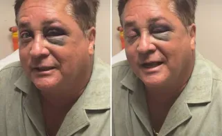 Imagem ilustrativa da imagem Cantor Leonardo sofre acidente e aparece com os olhos roxos e inchados