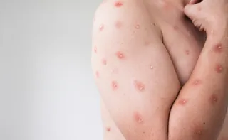 Imagem ilustrativa da imagem Espírito Santo confirma segundo caso de Mpox em 2026