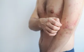 Imagem ilustrativa da imagem Ministério da Saúde alerta para risco de casos de sarampo após Copa