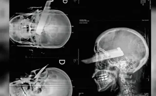 Imagem ilustrativa da imagem Mulher fica com faca cravada no olho após tentativa de feminicídio em SC