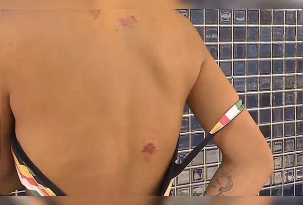 Mulher foi mordida pelo marido e teve várias lesões pelo corpo