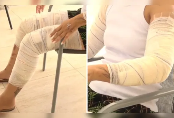 Mulher sofreu lesões nos braços e nas pernas