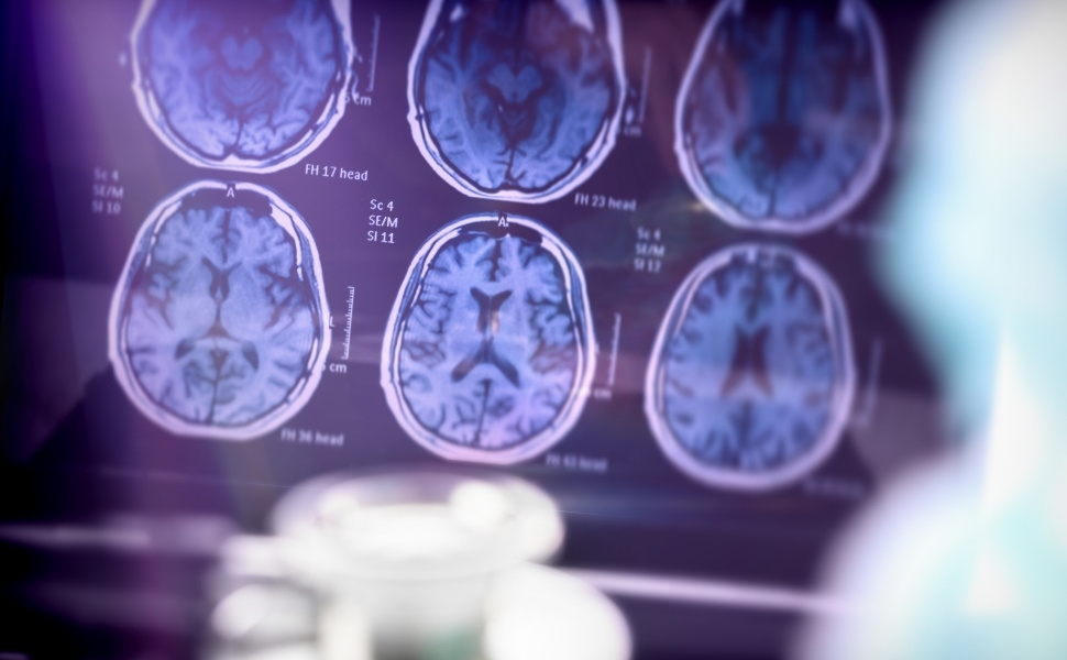 Alzheimer &eacute; a segunda doen&ccedil;a mais temida pelos brasileiros, atr&aacute;s apenas do  c&acirc;ncer | Tribuna Online | Seu portal de Not&iacute;cias