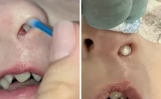 Imagem ilustrativa da imagem Em caso raro, dente nasce dentro do nariz de criança de 3 anos no Paraná