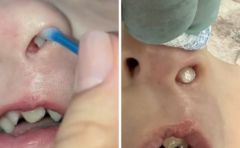 Em caso raro, dente nasce dentro do nariz de criança de 3 anos no Paraná