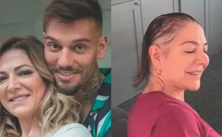 Imagem ilustrativa da imagem Alopecia: causas e tratamentos da doença que afeta famosos