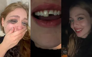 Imagem ilustrativa da imagem Jovem quebra dente na balada, cola na madrugada e volta para a festa
