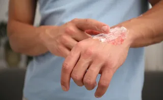 Imagem ilustrativa da imagem Queimaduras: prevenção ainda é o melhor tratamento