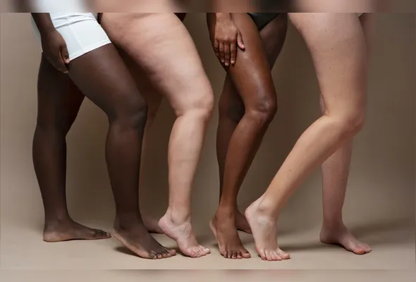 Imagem ilustrativa da imagem Tratamentos mais modernos contra o lipedema