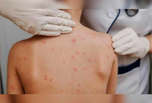 A sarna humana, ou escabiose, é uma infecção na pele causada por um ácaro microscópico