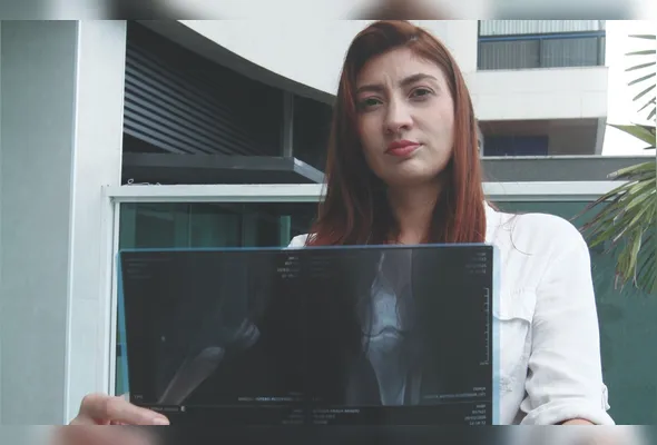 Amanda Braga foi atropelada 
por uma bike elétrica que vinha na contramão, fraturou um osso da parte inferior da perna e precisou passar por cirurgia e sessões de fisioterapia