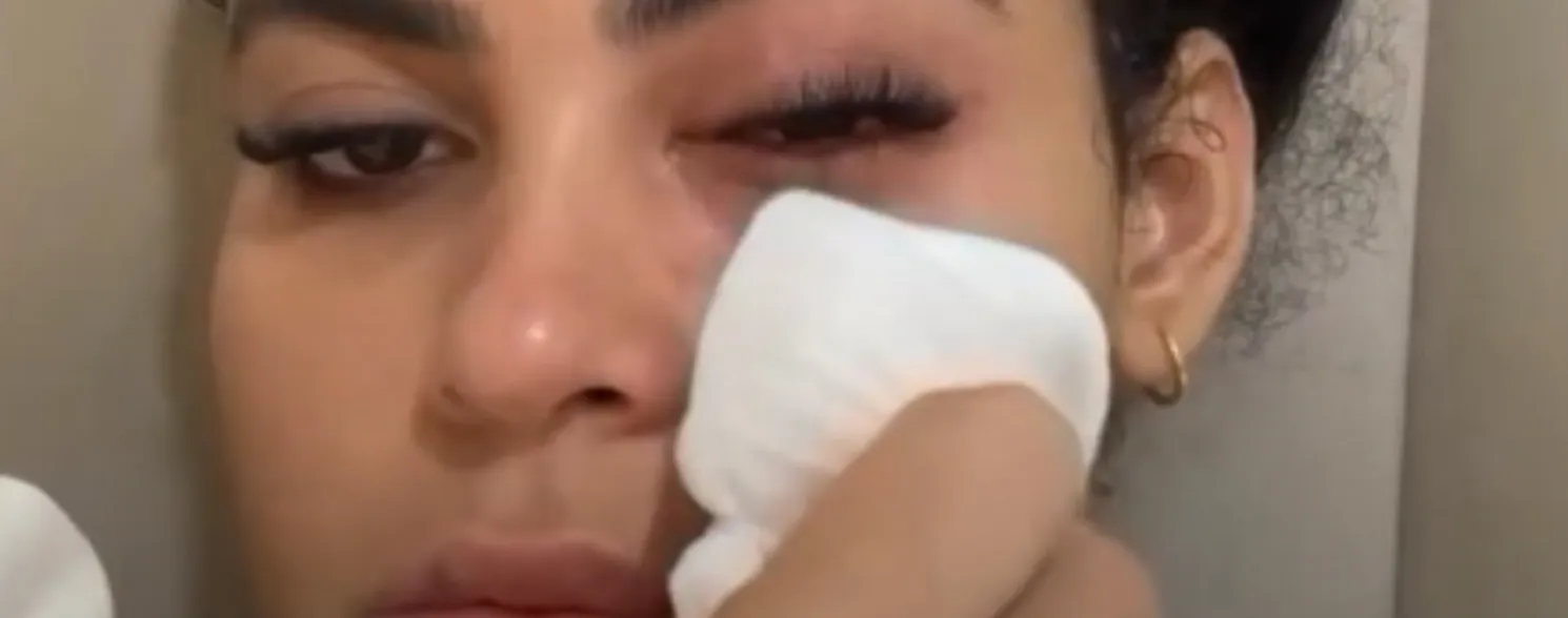 Imagem ilustrativa da imagem Influenciadora contrai infecção causada por mosca de banheiro na Serra
