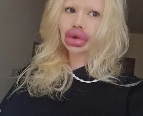 Imagem ilustrativa da imagem Mulher com maiores lábios do mundo diz que dentistas não querem atendê-la
