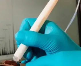 Imagem ilustrativa da imagem Caneta que detecta câncer durante cirurgia chega ao País