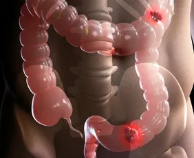 Imagem ilustrativa da imagem Estudo projeta aumento de 36% em mortes por câncer colorretal até 2040