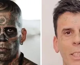 Imagem ilustrativa da imagem Homem mais tatuado do Brasil está irreconhecível após remoção de tatuagens