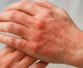 Imagem ilustrativa da imagem Brasil segue líder mundial em mortes por Chagas, aponta estudo