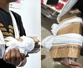 Imagem ilustrativa da imagem Criança tem braço imobilizado com papelão após fratura em UPA do RJ